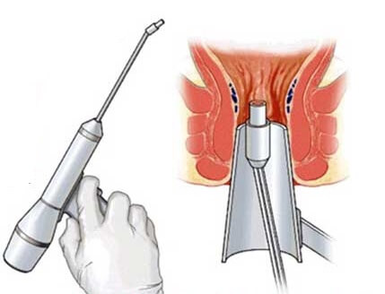 Cắt trĩ bằng laser